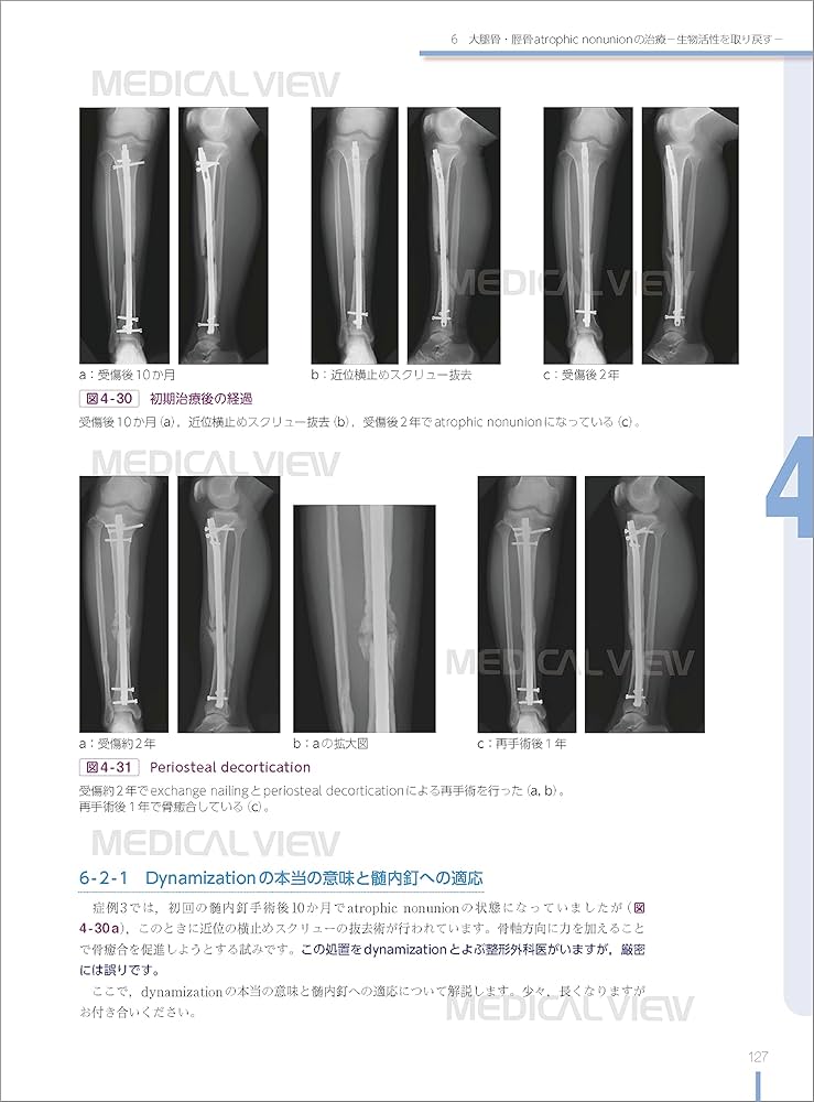 骨折合併症 : 白熱講義 : 骨折治療の物理学と生物学 : Nonunion,… 白熱講義 骨折合併症 Nonunion, Malunion, FRI, PTOA−骨折治療